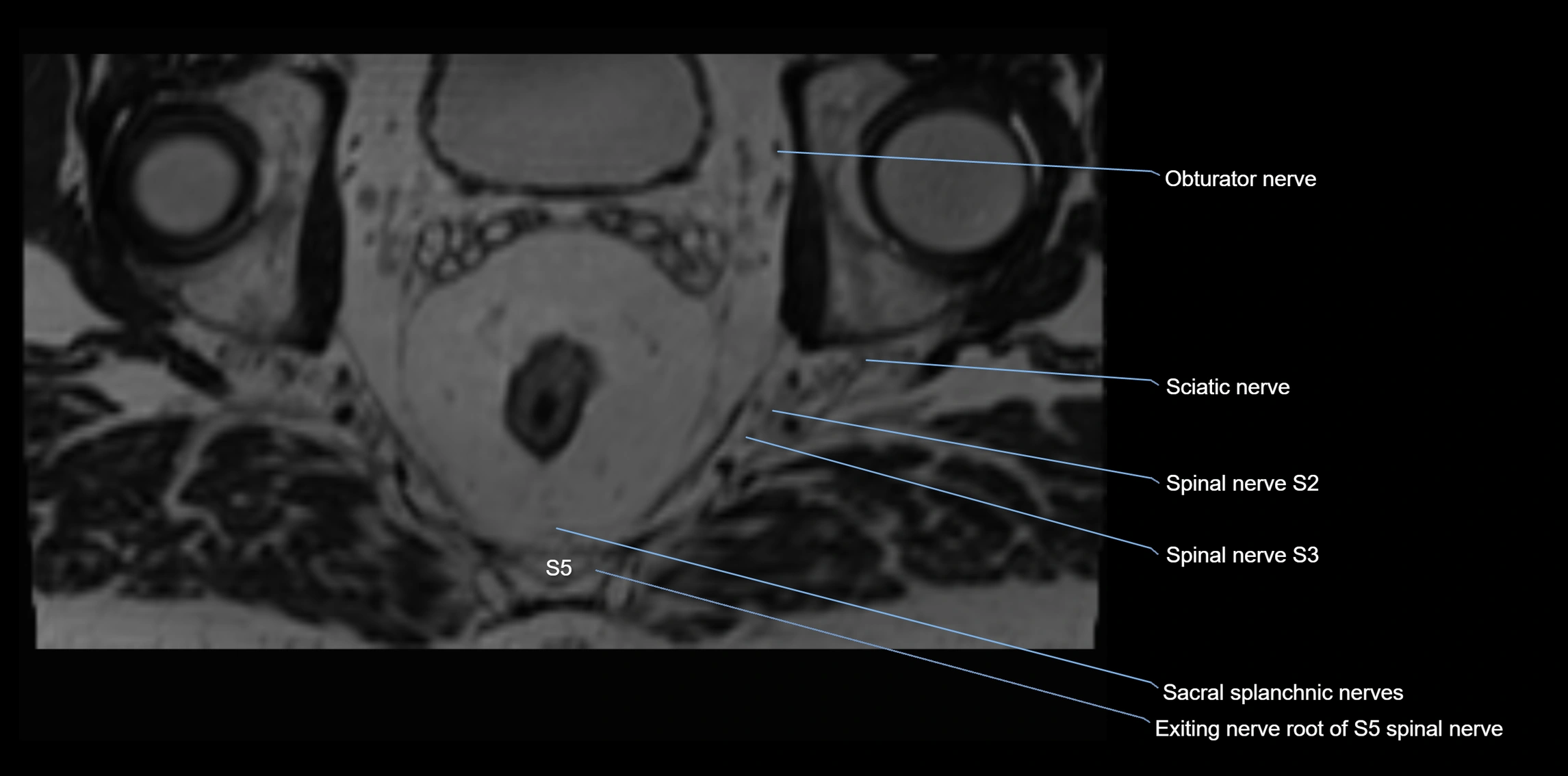MR lumbosacral plexus axial cross sectional anatomy 3T  radiology  image-img-1008001-00114.webp